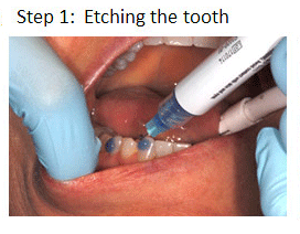 Invisalign step 1