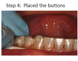 Invisalign step 4