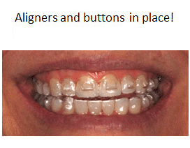 Invisalign step 5