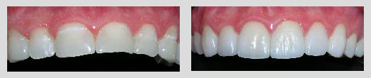 example of dental work by Dr. Ayan