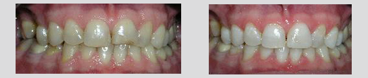 example of dental work by Dr. Ayan